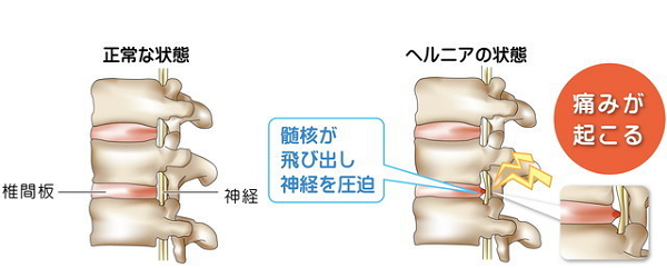 ヘルニアで腰痛が起こる説明