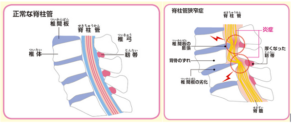 脊柱管狭窄症で腰痛が起こる説明