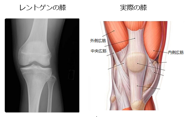 レントゲンで見る膝と実際の膝の違い