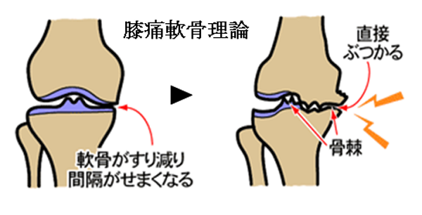 膝痛の軟骨理論