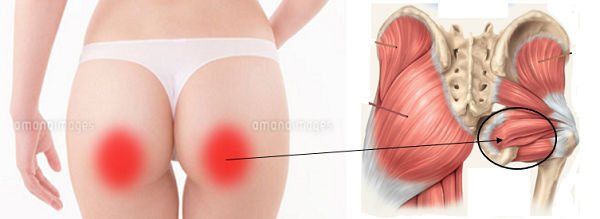 腰痛が起こる筋肉 お尻が痛い