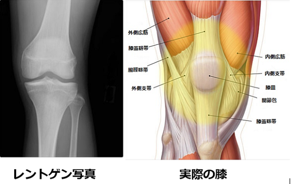 膝の皿の下や皿の周りが痛い場合の膝痛原因と解消代替医療