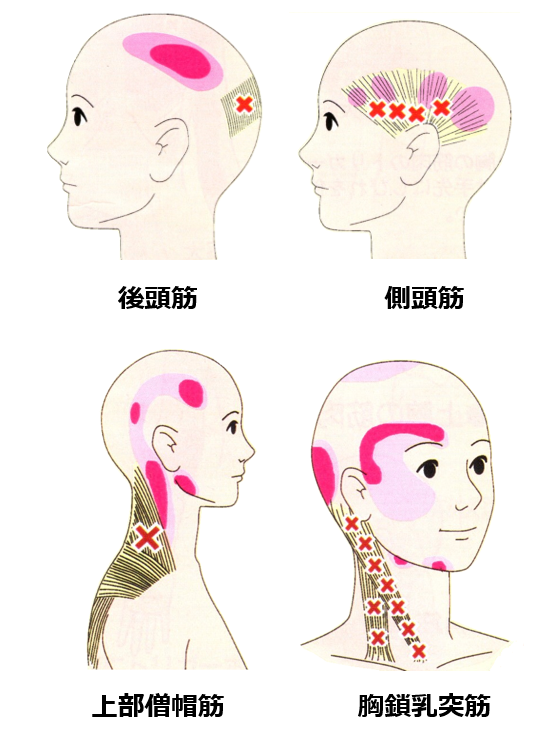 頭痛の原因になりやすい頭の筋肉