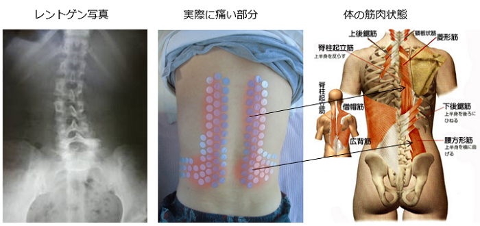 レントゲン写真と実際の腰痛の原因となっている筋肉の比較